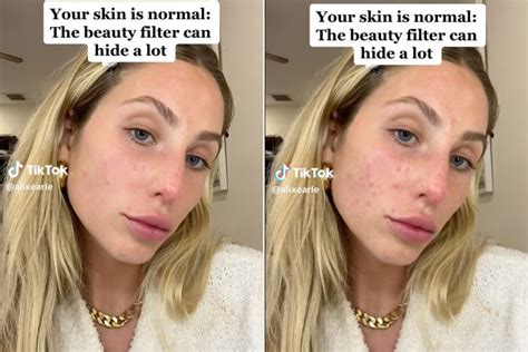 alix earle before accutane|Alix Earle Discusses Acne, Accutane And TikTok。